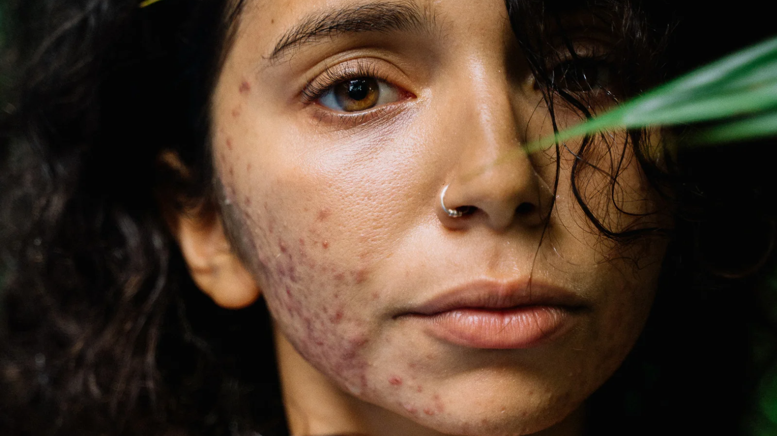 Advanced Acne Class 2 | crossan skincare